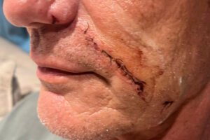 qui si vede la ferita inflitta dall'Aguglia